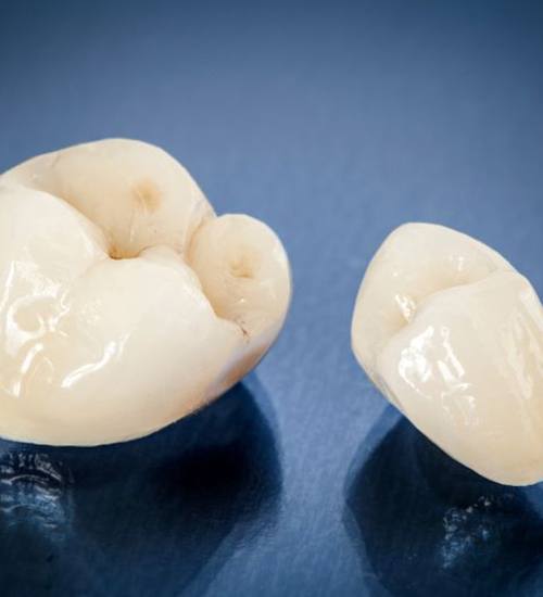 Close-up of two metal-free dental crowns