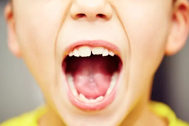 My Child Chipped a Tooth: What Should I Do?